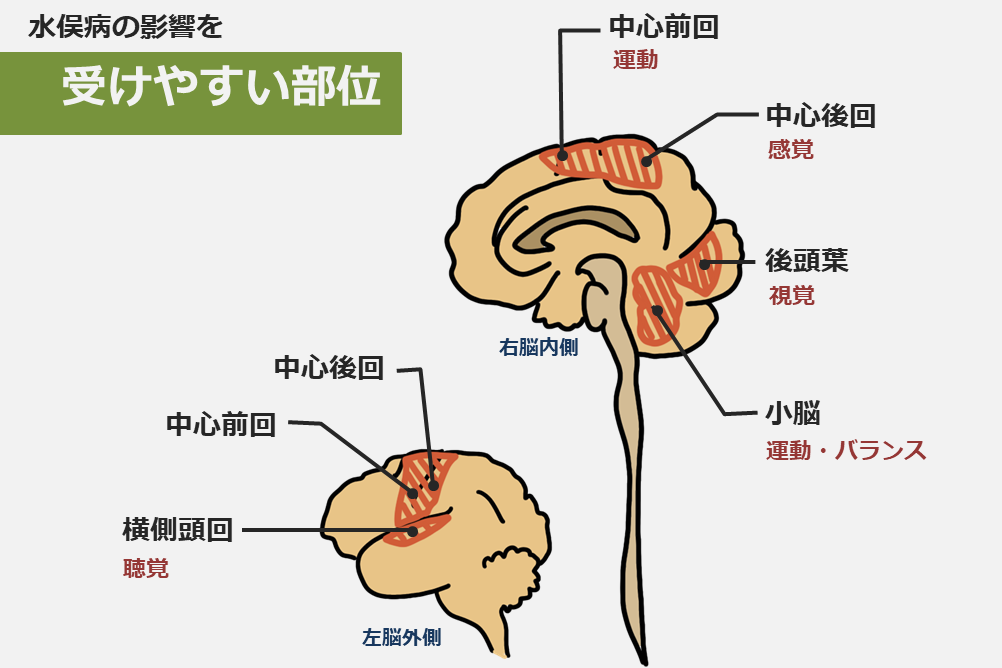 水俣病から何を学ぶか Dolinote
